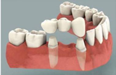 烤瓷牙的價(jia) 格