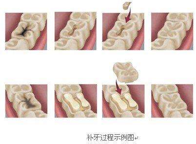 成人補牙過程