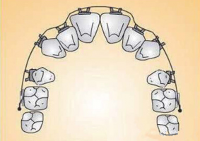 牙齒不齊要不要拔牙矯正