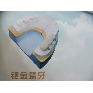 鈀金烤瓷牙價(jia) 格