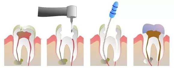兒(er) 童齲齒治療