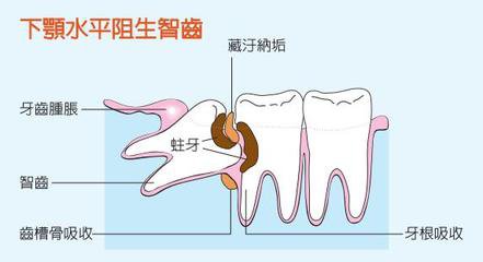 拔智齒後腫痛怎麽(me) 辦