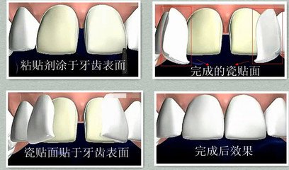 瓷貼麵多少錢一顆