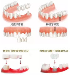 種牙好和烤瓷牙哪個(ge) 好