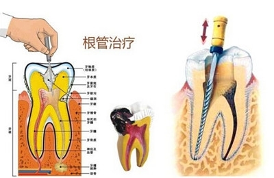  殺神經的牙壽命是多久