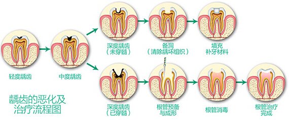蟲牙掉了牙根還在