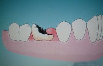 懷孕期間蛀牙疼