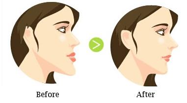 地包天帶牙套能矯正嗎