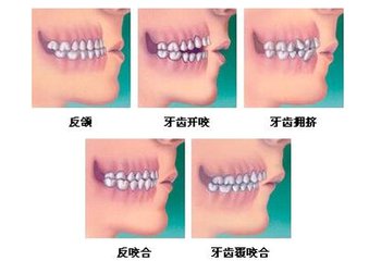 兒(er) 童矯正的時間
