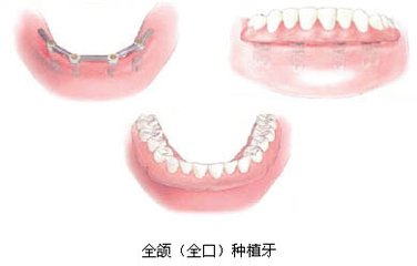 種植牙全口多少錢