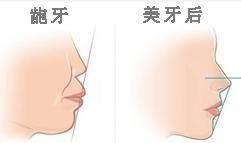 正畸拔牙後臉型變化圖