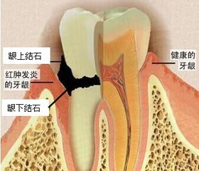 一般洗牙一次多少錢