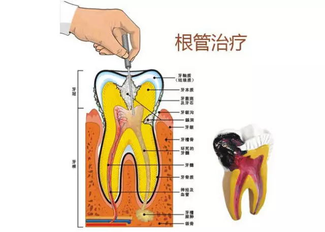 做根管治療會(hui) 痛嗎