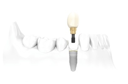 牙齒缺失的危害