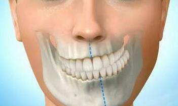 牙齒中線不齊錯頜