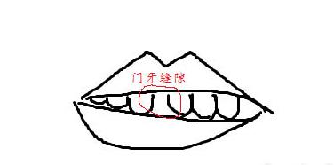 牙齒縫大可以直接補嗎