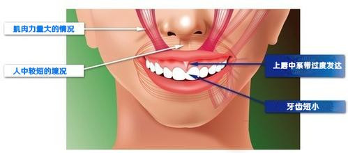 小孩笑露牙齦的原因
