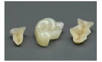 全冠修複好還是嵌體(ti) 好