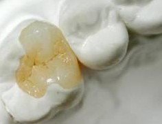 嵌體(ti) 補牙能用多長時間