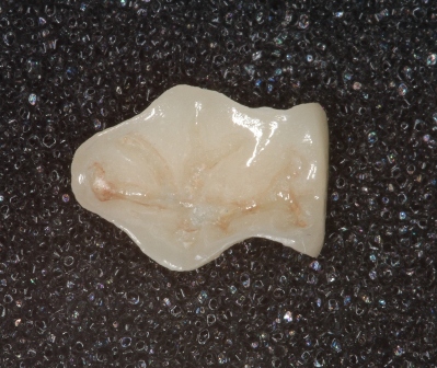 嵌體(ti) 補牙多少錢