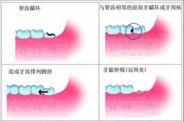 立事牙引發的牙齒症狀