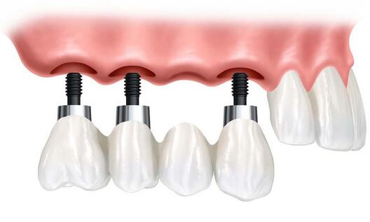 老年人全口假牙