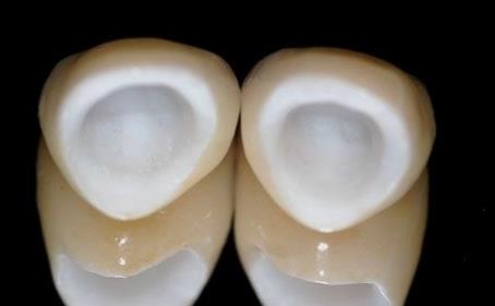 烤瓷牙密封不好怎麽(me) 辦