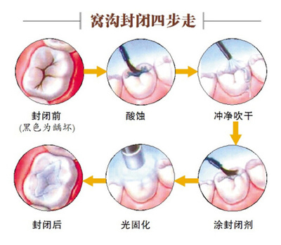 牙齒窩溝封閉的步驟