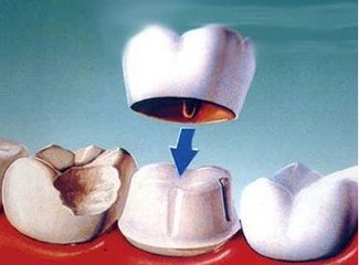 補牙後要不要做牙套