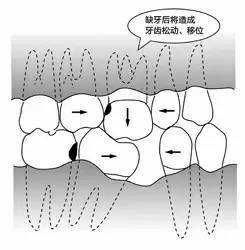 拔牙後鄰牙傾(qing) 斜怎麽(me) 辦