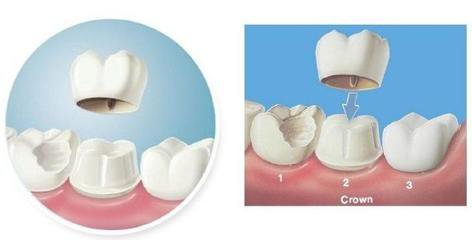 深圳美容冠多少錢