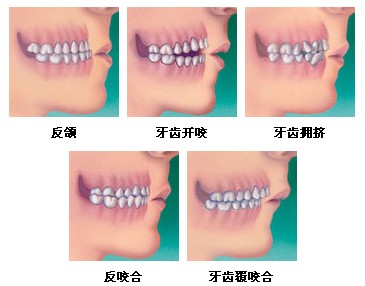 正頜正畸會(hui) 有後遺症嗎