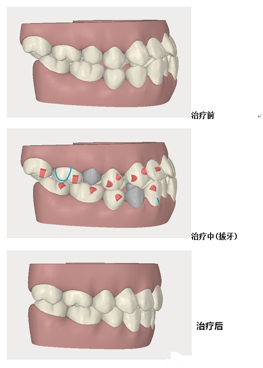 牙齒正畸調整咬合