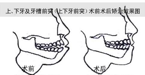 牙齒大門牙突出怎麽(me) 辦