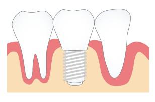 種植牙治療誤區