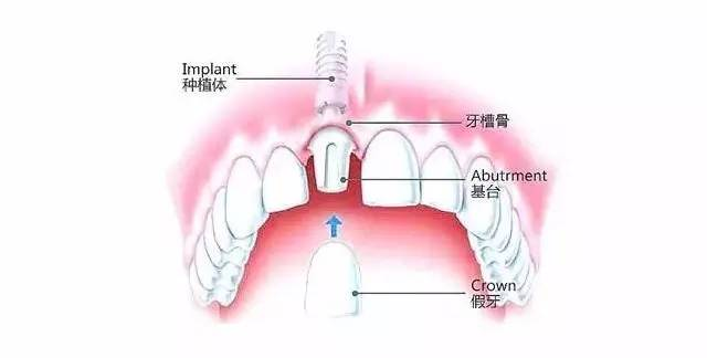 種植牙是怎麽(me) 種上去的