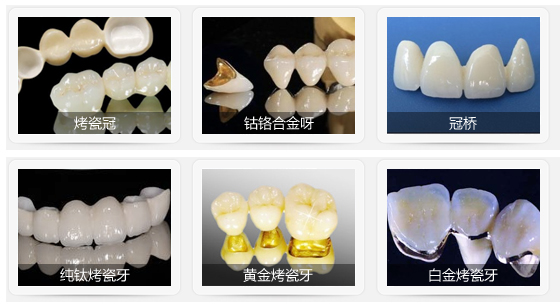 烤瓷牙報價(jia) 是多少