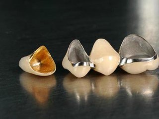貴金屬烤瓷牙