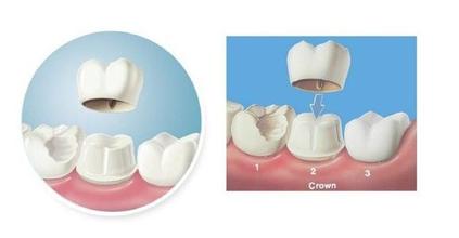 四環素牙烤瓷牙美白