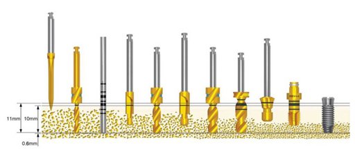 種植牙後鬆動是怎麽(me) 回事