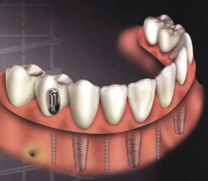 多顆種植牙能一次性做完嗎