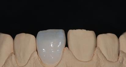 全瓷牙要怎樣修複才好