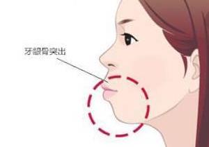 30歲了牙齒還能矯正嗎