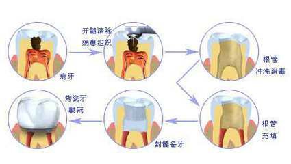 根管治療後牙齒的壽命