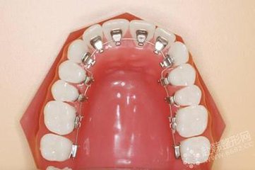 舌側(ce) 隱形牙套要戴多久