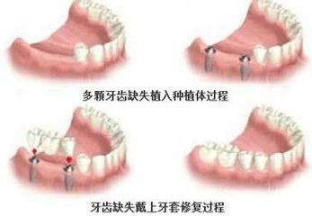 多個(ge) 牙齒缺失