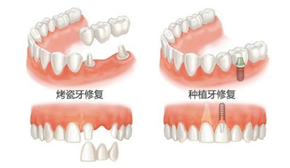 固定假牙修複
