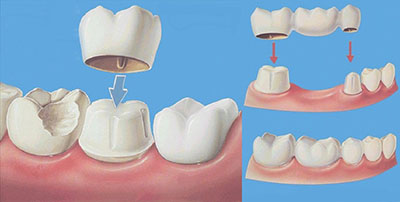裝烤瓷牙套要磨鄰牙嗎