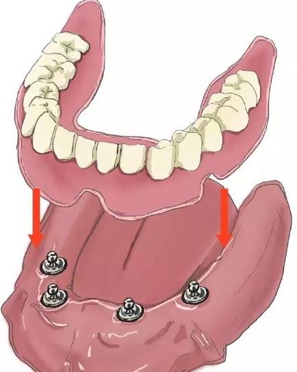 全口種植牙的價(jia) 格