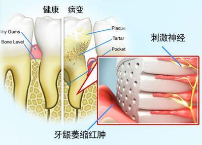 牙齦萎縮能恢複嗎